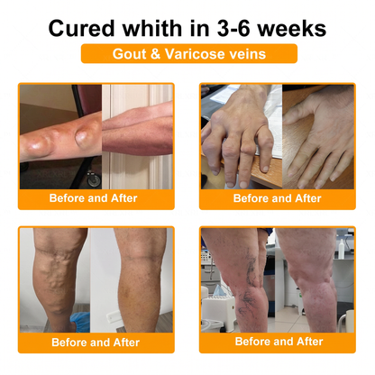 30% Discount🎁🎁|𝐌𝐔𝐑𝐖𝐎𝐍® Bee Venom Pain-Relief Bone Healing Cream ✨✨✨(Specially for older adults)